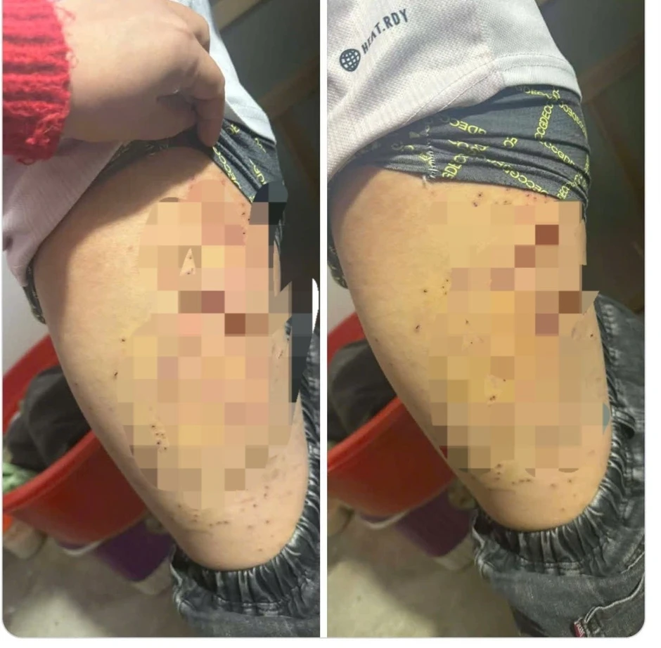 Nữ sinh lớp 7 bị bạn dùng bút bi đâm chi chít vào đùi Nữ sinh lớp 7 bị bạn dùng bút bi đâm chi chít vào đùi