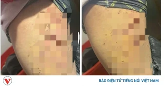 Nữ sinh lớp 7 bị bạn dùng bút bi đâm chi chít vào đùi