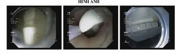 Suýt thủng dạ dày vì sự cố nuốt bàn chải đánh răng khi vệ sinh lưỡi Suýt thủng dạ dày vì sự cố nuốt bàn chải đánh răng khi vệ sinh lưỡi