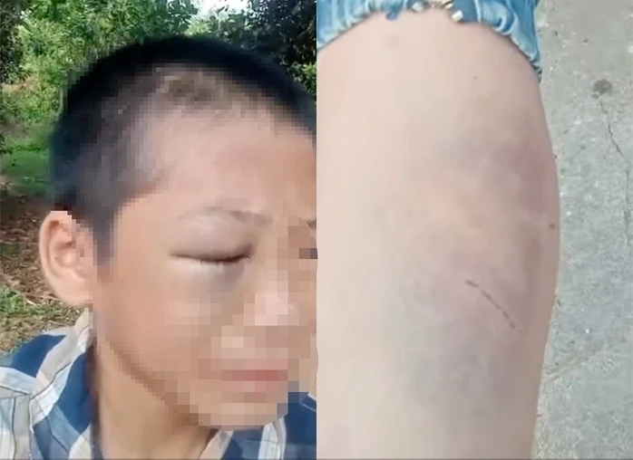 Thông tin mới vụ cháu bé 12 tuổi nghi bị bố, mẹ kế đánh bầm tím khắp người Thông tin mới vụ cháu bé 12 tuổi nghi bị bố, mẹ kế đánh bầm tím khắp người