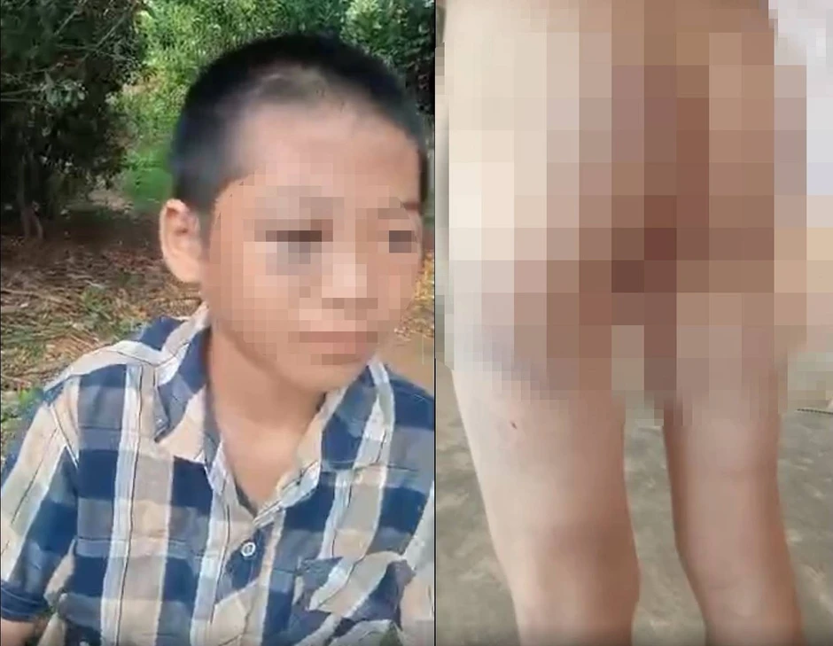 Trẻ lớp 6 nghi bị mẹ kế và bố bạo hành: 'Cháu rửa bát, quét nhà không sạch nên bị đánh' Trẻ lớp 6 nghi bị mẹ kế và bố bạo hành: 'Cháu rửa bát, quét nhà không sạch nên bị đánh'