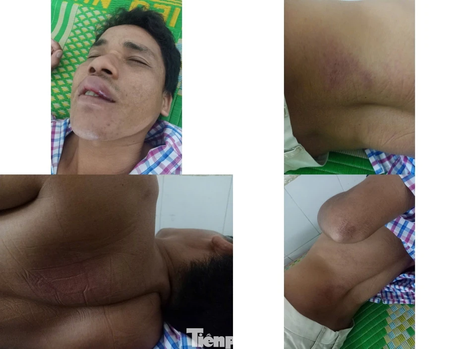 Vụ bị đánh đến 'thân tàn ma dại': 3 bị cáo lĩnh hơn 10 năm tù, bồi thường 315 triệu đồng Vụ bị đánh đến 'thân tàn ma dại': 3 bị cáo lĩnh hơn 10 năm tù, bồi thường 315 triệu đồng