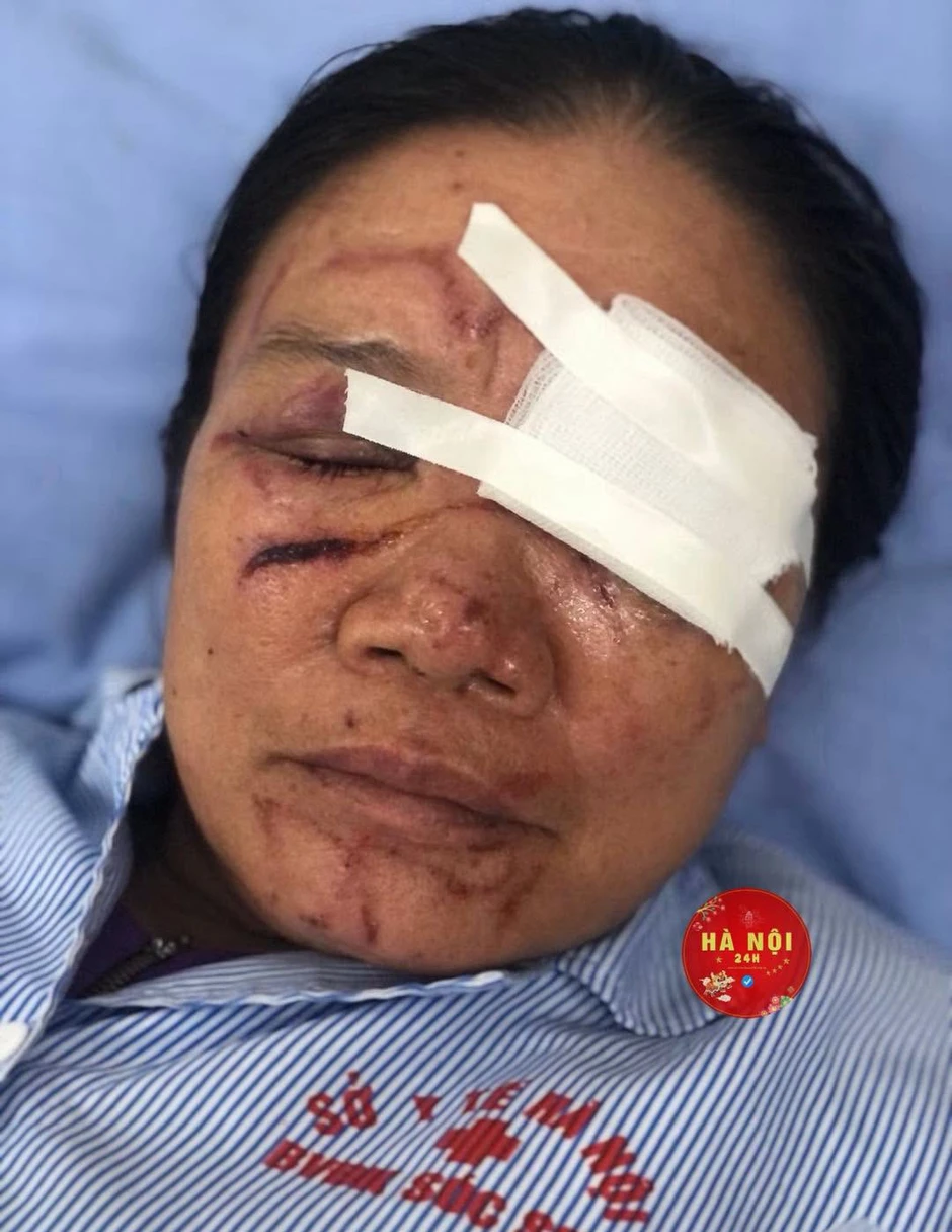 Vụ tiểu thương bị xịt nước chảy máu mắt ở Phú Thọ: Nạn nhân vẫn đau nhức, hoảng loạn