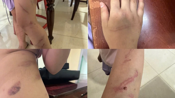 Xác minh vụ bé gái 9 tuổi có 34 vết bầm nghi bị bạo hành ở Đắk Lắk Xác minh vụ bé gái 9 tuổi có 34 vết bầm nghi bị bạo hành ở Đắk Lắk